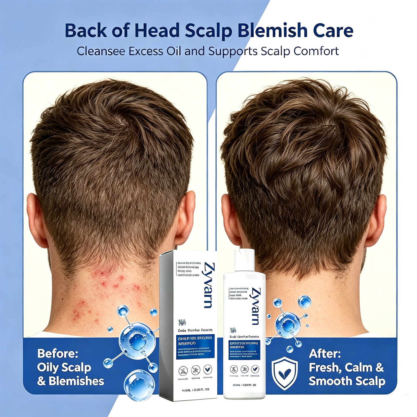 Scalp Nourishing Shampoo to Reduce Back Head Acne & Flakes