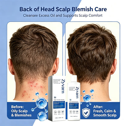 Scalp Nourishing Shampoo to Reduce Back Head Acne & Flakes