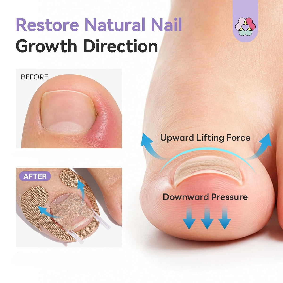 100 SET Ingrown Toenail Correction Treatment Tool, Ingrown Toenail Strips